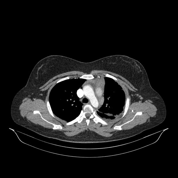 File:Chronic thromboembolic pulmonary hypertension (CTEPH) (Radiopaedia 74597-85532 Axial C+ CTPA 113).jpg