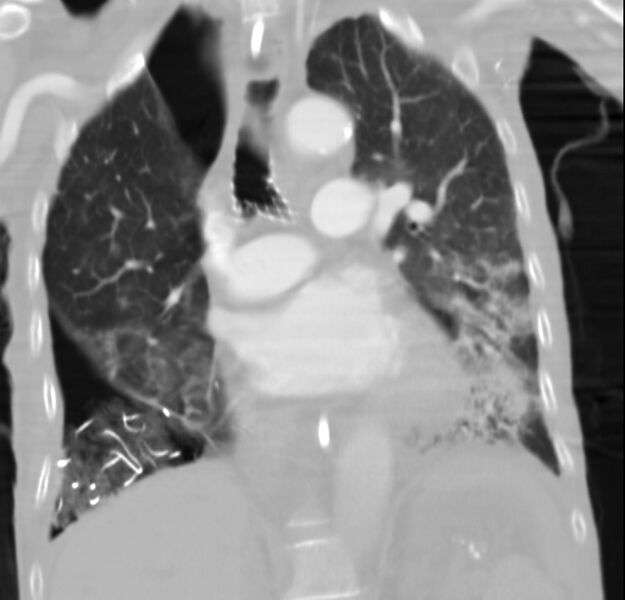 File:Clagett thoracotomy with bronchopleural fistula (Radiopaedia 29192-29587 Coronal lung window 16).jpg