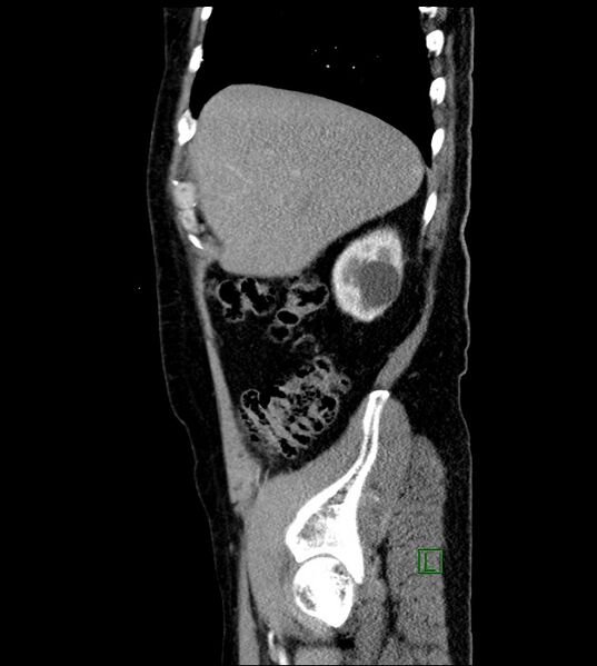 File:Clear cell renal cell carcinoma (Radiopaedia 85006-100539 E 49).jpg