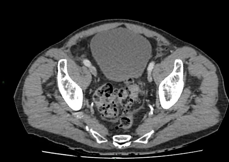 File:Closed loop small bowel obstruction with ischemia (Radiopaedia 84180-99456 A 102).jpg