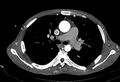 Coarctation of aorta with aortic valve stenosis (Radiopaedia 70463-80574 A 68).jpg