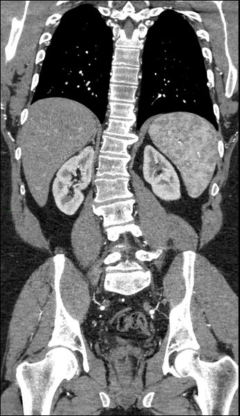 File:Coarctation of the aorta (Radiopaedia 74632-88521 B 169).jpg