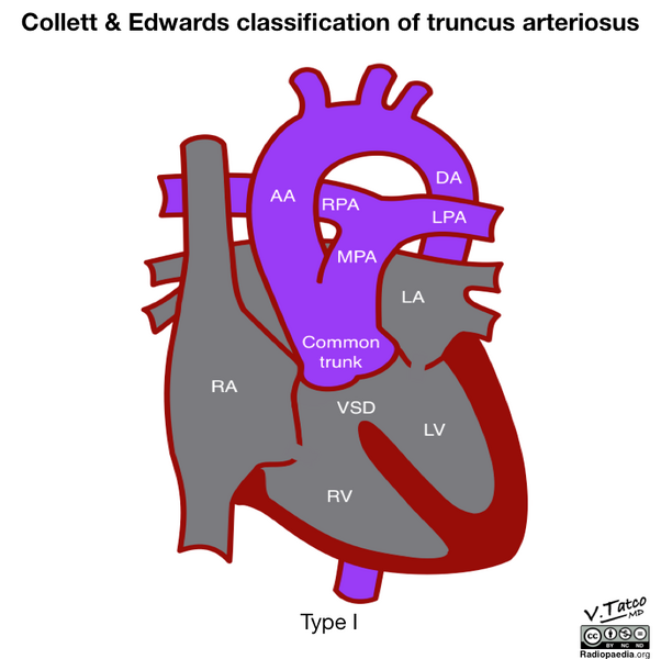 File:Collett and Edwards classification of truncus arteriosus (diagram) (Radiopaedia 51895-57733 B 1).png