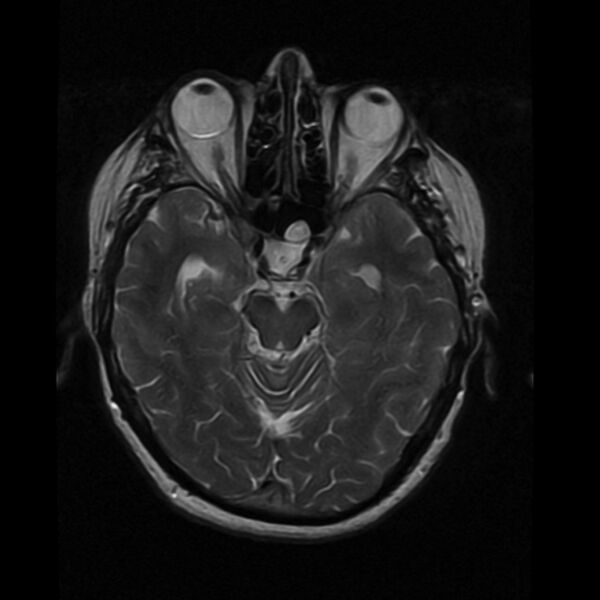 File:Colloid cyst with hydrocephalus (Radiopaedia 9373-10065 Axial T2 7).jpg