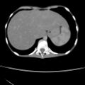 Colocolic fistula - Crohn disease (Radiopaedia 57063-63955 A 6).jpg