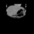Colocolic fistula - Crohn disease (Radiopaedia 57063-63955 B 4).jpg