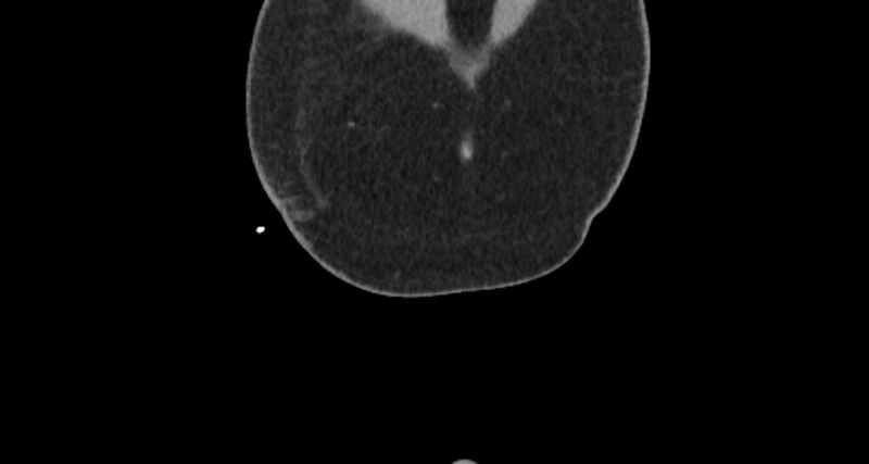 File:Colocutaneous fistula (Radiopaedia 56401-63062 C 1).jpg