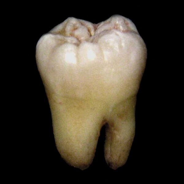 File:Molar tooth (photo) (Radiopaedia 8240).jpg