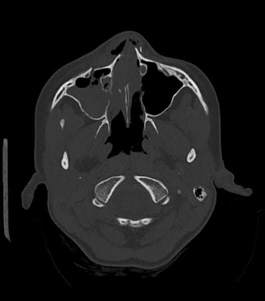 File:Nasoorbitoethmoid fracture (Radiopaedia 90044-107205 Axial bone window 64).jpg