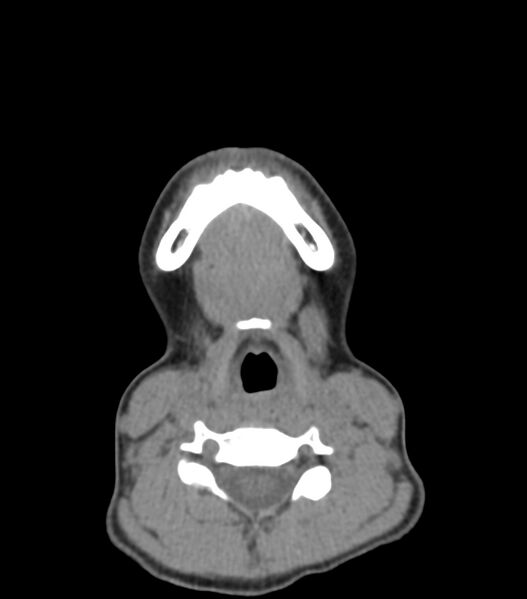File:Nasoorbitoethmoid fracture (Radiopaedia 90044-107205 Axial non-contrast 37).jpg