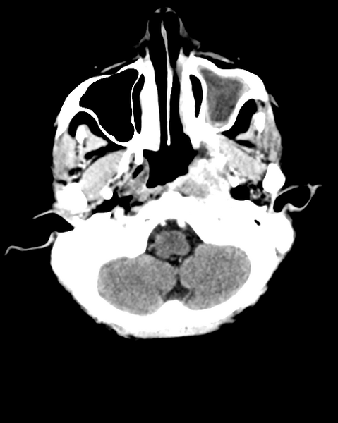 File:Nasopharyngeal carcinoma with cerebral abscess (Radiopaedia 43018-46275 Axial C+ delayed 9).png