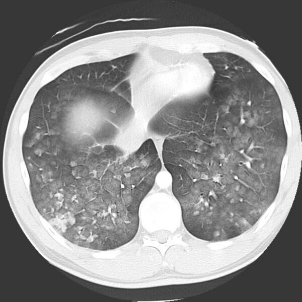 File:Near drowning pulmonary edema (Radiopaedia 16868-16591 Axial lung window 41).jpg