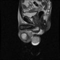 Necrotizing epididymo-orchitis with intra-testicular abscess (Radiopaedia 29397-29860 Sagittal T2 11).jpg