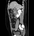Necrotizing pancreatitis (Radiopaedia 23001-23031 C 24).jpg