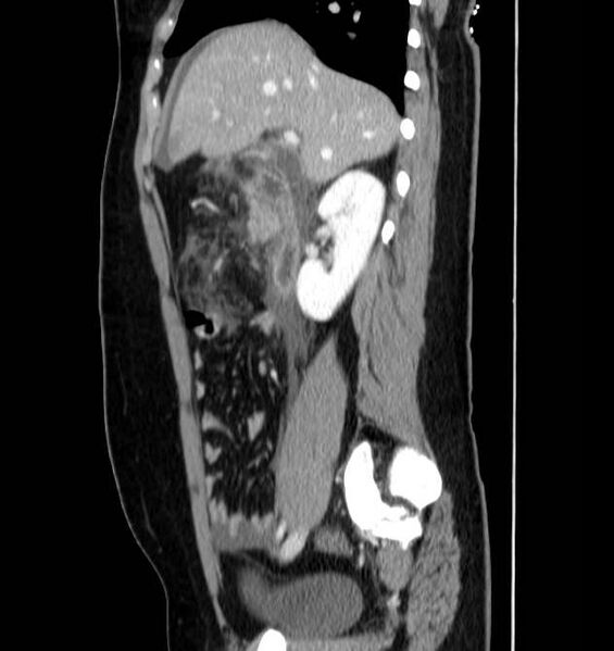 File:Necrotizing pancreatitis (Radiopaedia 23001-23031 C 24).jpg