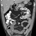Necrotizing pancreatitis with acute necrotic collection (Radiopaedia 14470-14417 C 10).jpg