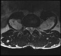 Neurofibromatosis type 1 (Radiopaedia 11671-12034 Axial T2 1).jpg
