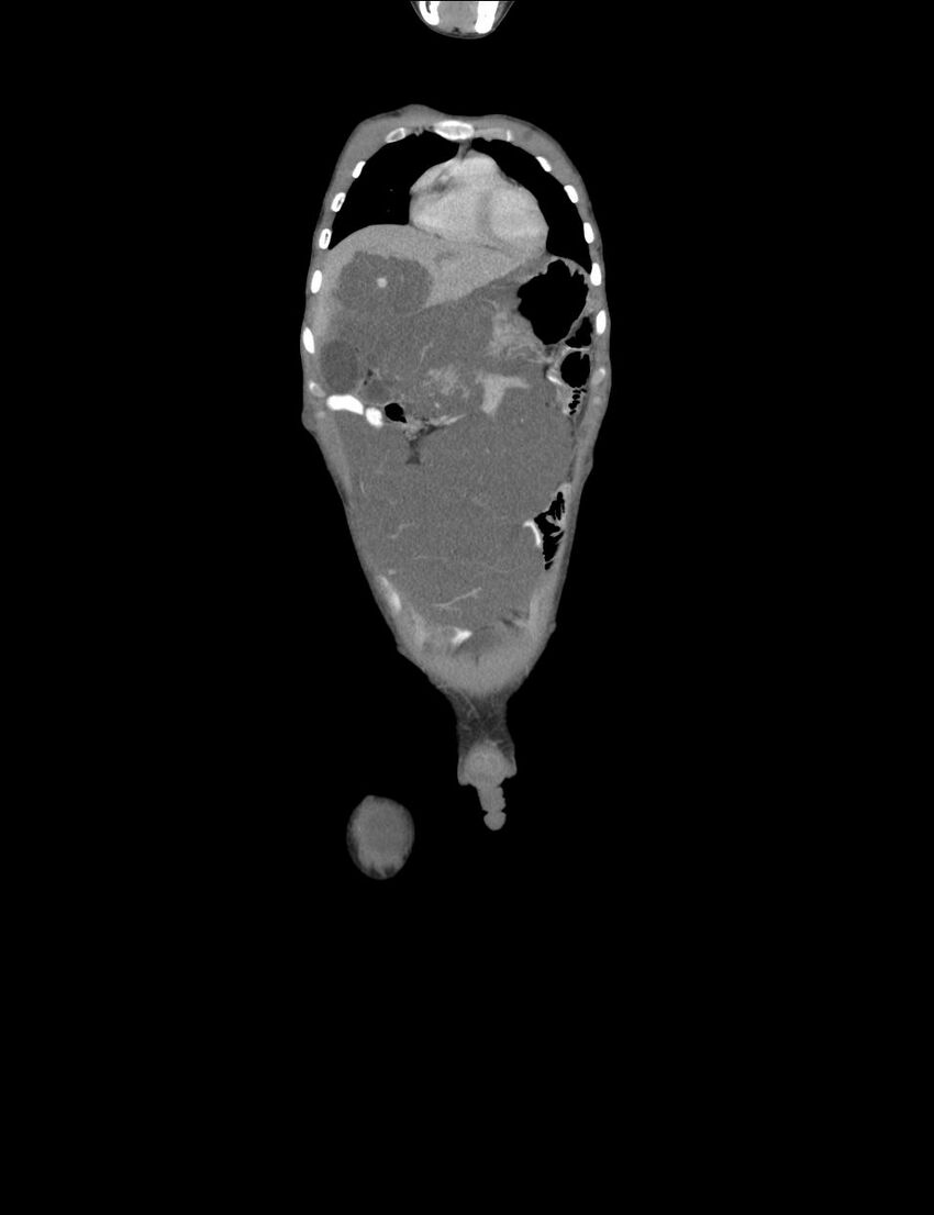 Neurofibromatosis type 1 (Radiopaedia 49538-54733 B 41).jpg