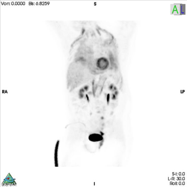 File:Non-Hodgkin lymphoma involving seminal vesicles with development of interstitial pneumonitis during Rituximab therapy (Radiopaedia 32703-33761 PET cor 3D MIP 2).jpg
