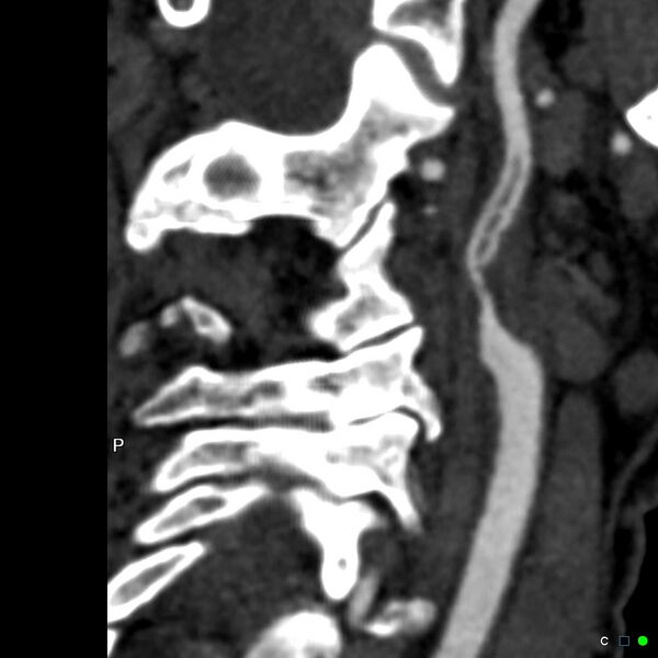 File:Non-occlusive intraluminal internal carotid artery thrombus (Radiopaedia 37751-39658 A 27).jpg