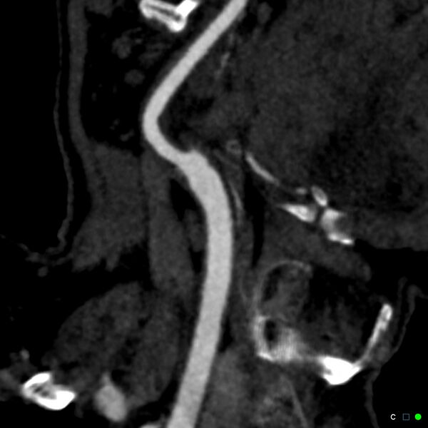 File:Non-occlusive intraluminal internal carotid artery thrombus (Radiopaedia 37751-39658 C 27).jpg