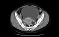 Non-puerperal uterine inversion (Radiopaedia 78343-91094 A 14).jpg