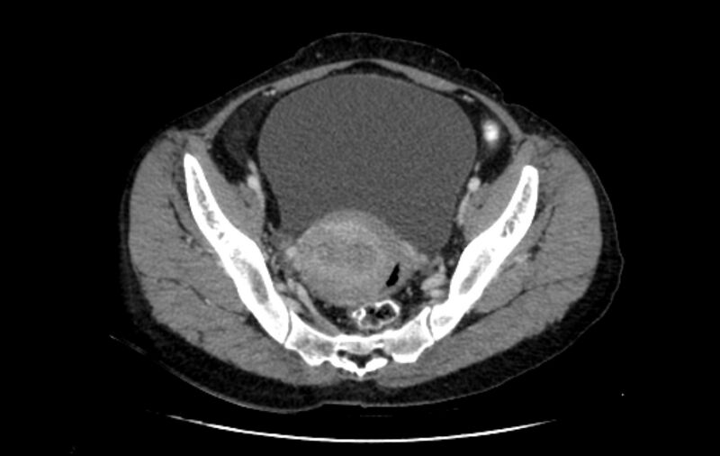 File:Non-puerperal uterine inversion (Radiopaedia 78343-91094 A 14).jpg