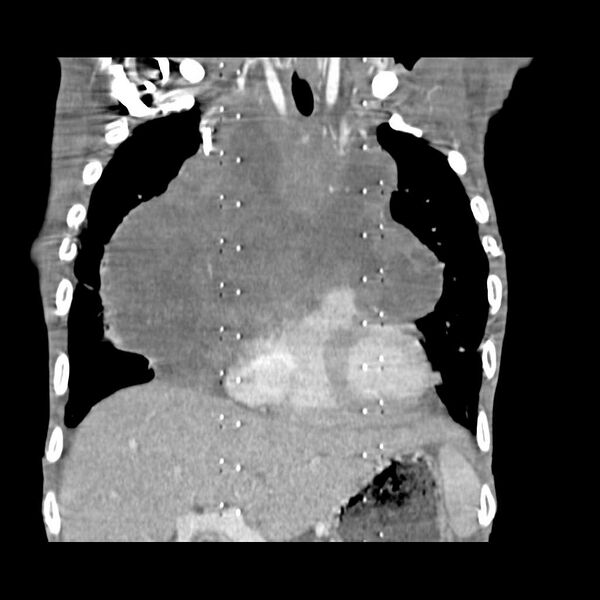 File:Non hodgkin lymphoma of the mediastinum (Radiopaedia 20814-20729 C 8).jpg