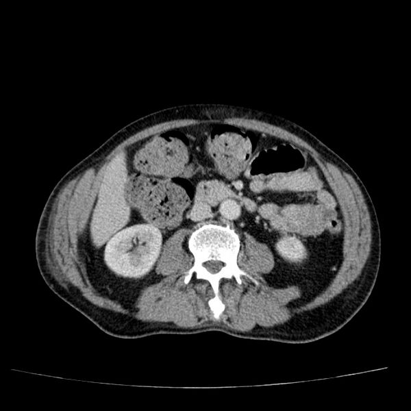 File:Non small-cell lung cancer (Radiopaedia 24467-24769 C+ delayed 79).jpg