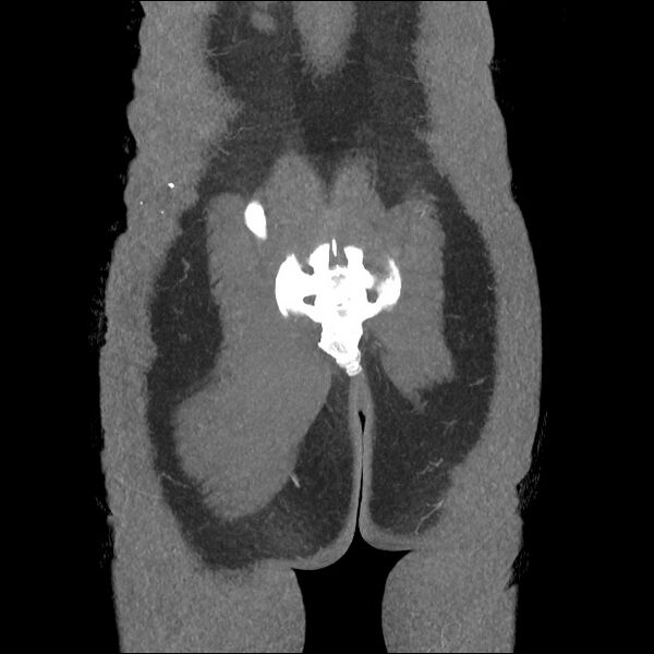 File:Normal CT angiogram of pelvis (Radiopaedia 45390-49430 B 44).jpg