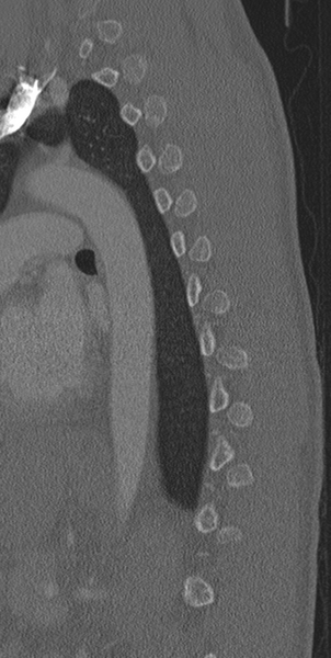 File:Normal CT thoracic spine (Radiopaedia 40181-42688 Sagittal bone window 18).png