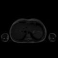 Normal MRI abdomen in pregnancy (Radiopaedia 88001-104541 Axial T2 6).jpg