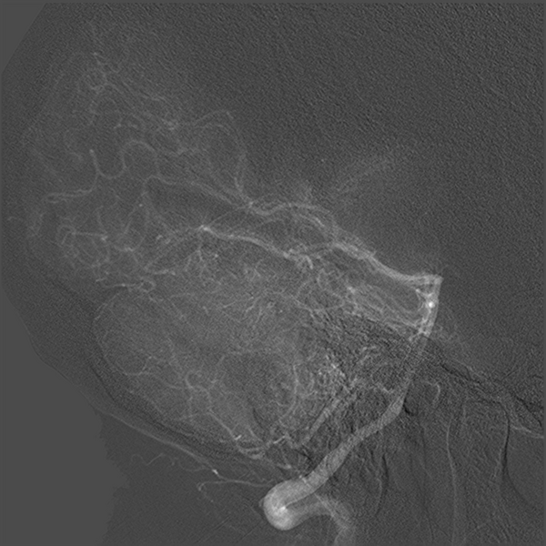 File:Normal cerebral angiogram (four vessel DSA) (Radiopaedia 41708-44649 R 14).png