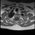 Normal cervical and thoracic spine MRI (Radiopaedia 35630-37156 Axial T1 C+ 5).png