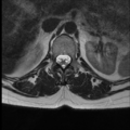 Normal cervical and thoracic spine MRI (Radiopaedia 35630-37156 H 5).png