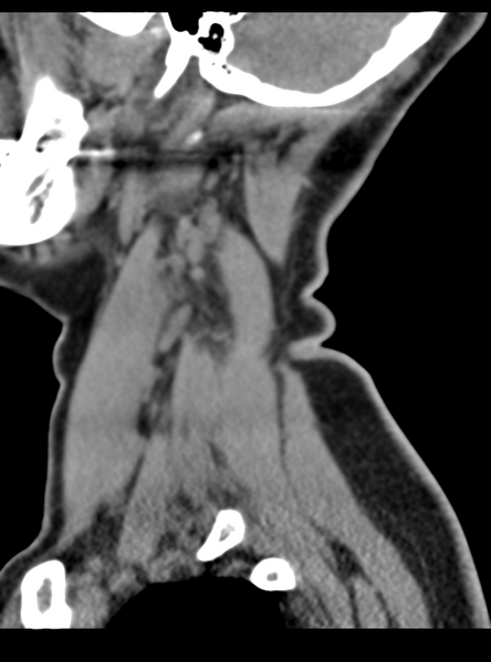 File:Normal cervical spine MRI (including Dixon) (Radiopaedia 42762-45926 C 6).png