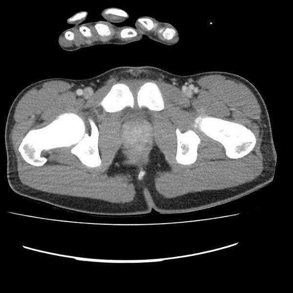 File:Normal dual-phase trauma CT chest,abdomen and pelvis (Radiopaedia 48092-52899 A 114).jpg