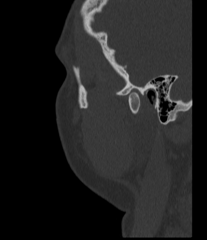 Normal facial bone CT (Radiopaedia 88742-105476 Sagittal bone window 143).jpg