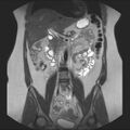 Normal liver MRI with Gadolinium (Radiopaedia 58913-66163 Coronal T2 20).jpg