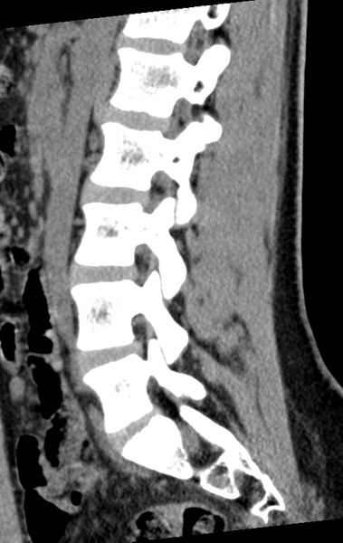 File:Normal lumbar spine CT (Radiopaedia 46533-50986 C 43).png