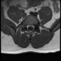 Normal lumbar spine MRI (Radiopaedia 35543-37039 Axial T1 11).png