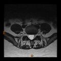 Normal spine MRI (Radiopaedia 77323-89408 Axial T2 22).jpg