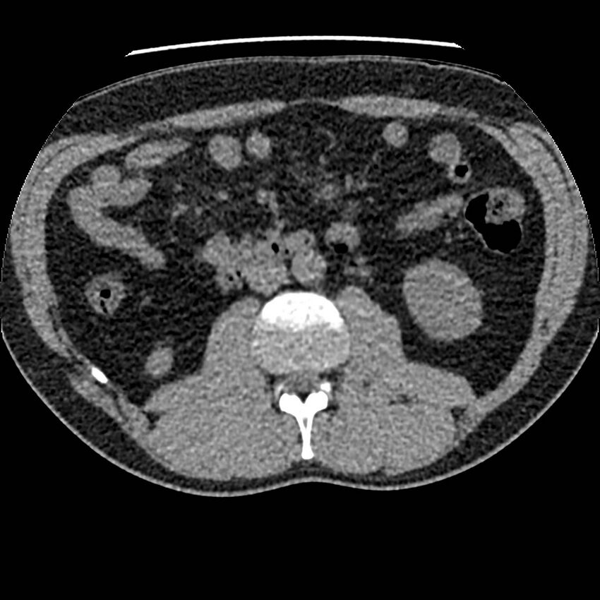 Obstructing ureteric calculus and ureteric anatomy (Radiopaedia 62730-71042 Axial non-contrast 57).jpg