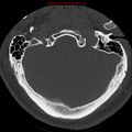 Occipital condyle fracture (Radiopaedia 18366-18208 Axial bone window 5).jpg