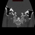 Occipital condyle fracture (Radiopaedia 18366-18208 Coronal bone window 10).jpg