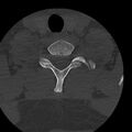 Occipital condyle fracture (Radiopaedia 31755-32691 Axial bone window 69).jpg