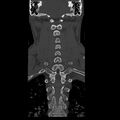 Occipital condyle fracture (Radiopaedia 31755-32691 Coronal bone window 23).jpg