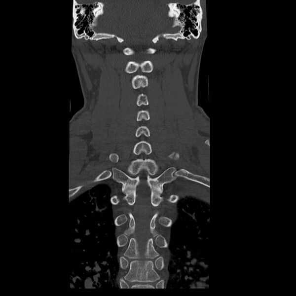 File:Occipital condyle fracture (Radiopaedia 31755-32691 Coronal bone window 23).jpg