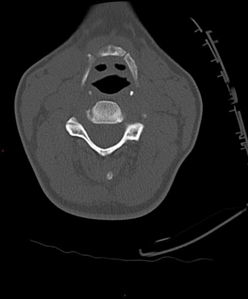 File:Occipital condyle fracture (Radiopaedia 61165-69056 D 15).jpg