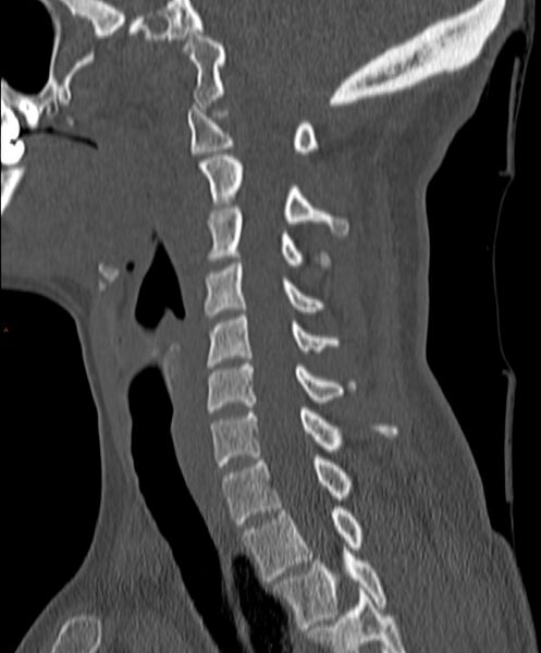 File:Occipital condyle fracture (Radiopaedia 61165-69056 Sagittal bone window 15).jpg